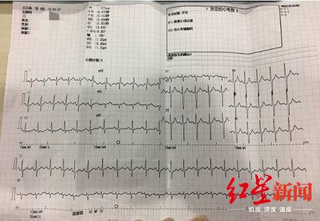 ▲白女士去医院检查的心电图结果