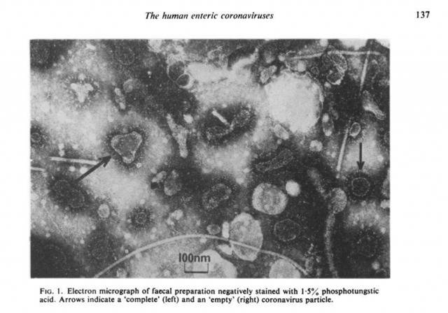上图：人类粪便中的人类肠道冠状病毒：左为完整冠状病毒，右边箭头所示为“空”病毒颗粒