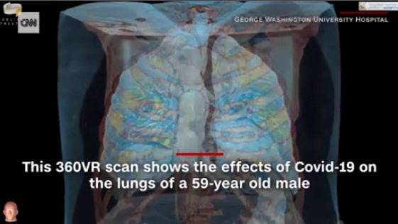 3D视频全方位展示了患者肺部感染情况。图据CNN新闻