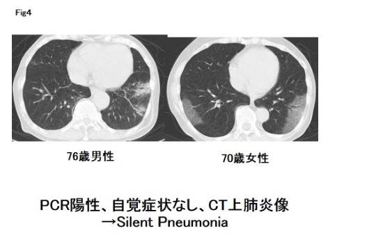 日本无症状患者的肺部影像。/日本自卫队中央医院网站