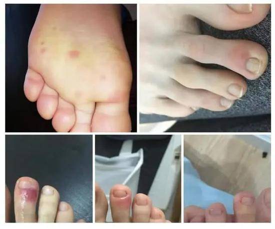 新症状！研究人员称新冠肺炎年轻患者脚部可能出现紫色块
