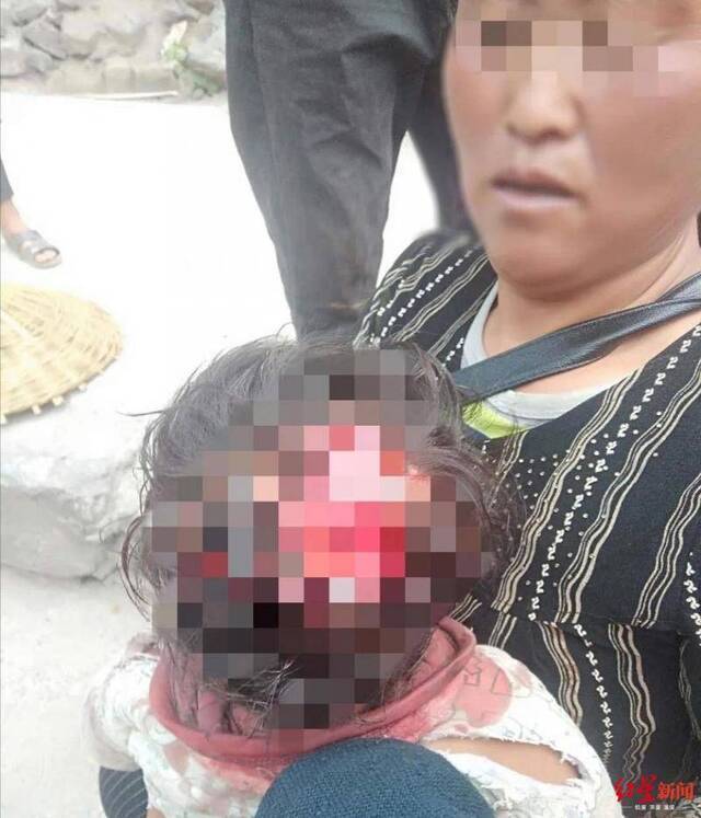 四川凉山一村庄野猴出没，两小孩被咬伤住院，其中3岁娃受伤较重