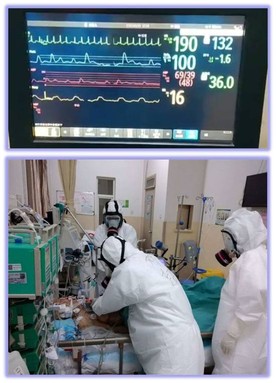 陕西最危重新冠患者痊愈 使用ECMO49天 病历达1600页