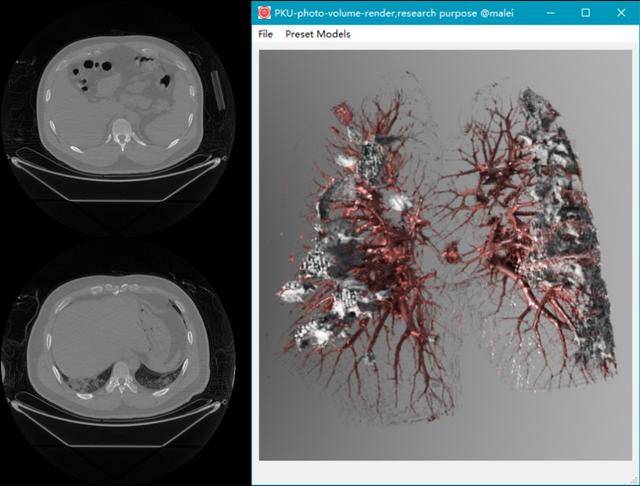 左侧是传统的胸部CT图像，右侧是北大高真实感体渲染技术对CT图像集的高真实感可视化图片来自北大新闻网