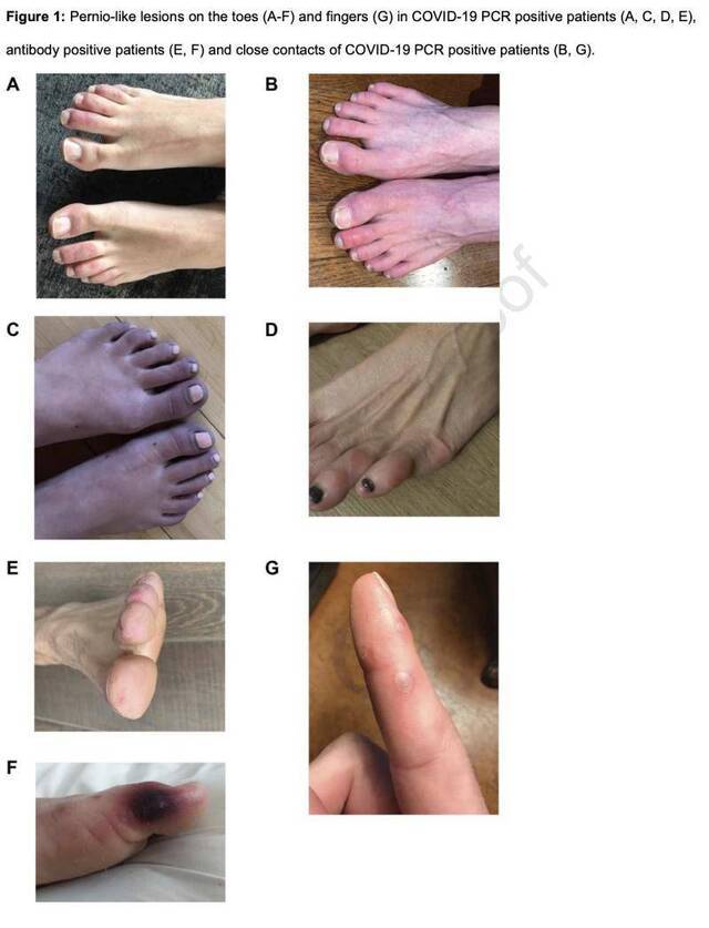新冠病毒可令患者出现冻疮样皮肤病变：多见于年轻、健康患者