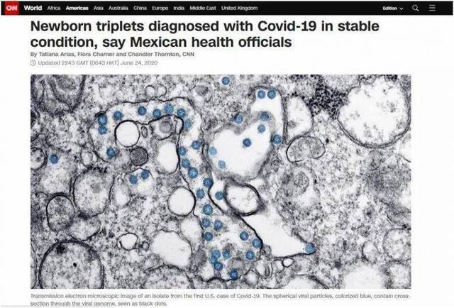  CNN24日报道：墨西哥卫生官员表示，确诊感染新冠病毒的三胞胎病情稳定