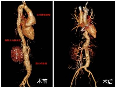 四川首例！医生8小时将整根主动脉换成人工血管