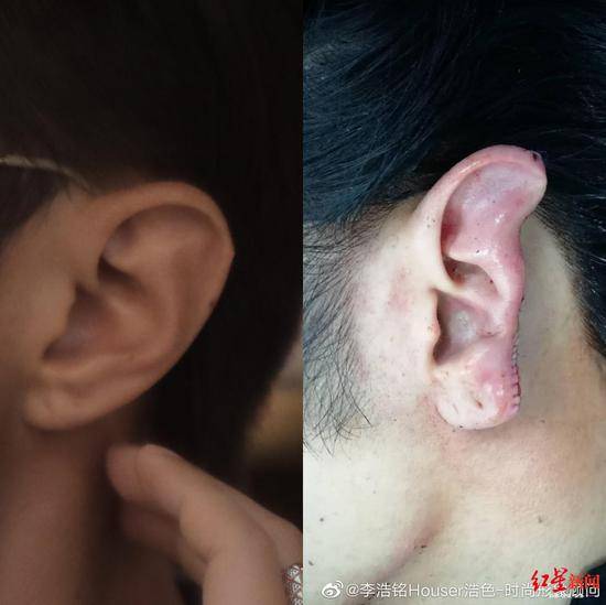 ↑李浩铭左耳受伤前后照片。