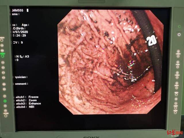 ↑手术后，胃里的头发基本被清除干净四川大学华西医院供图