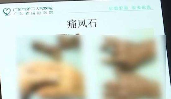 18岁男孩手脚长满“钻石”竟是因爱喝这种饮料