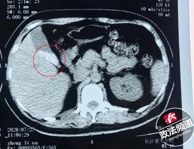 ▲患者术前CT，红圈内白色部分为胆囊结石