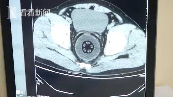 直肠取出20厘米“木瓜”小伙称“不小心塞入”