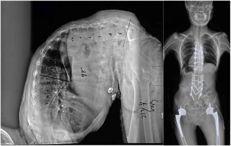 △术前小玉脊柱X线侧位片（左）和术后小玉的站立位全身X线正侧位片