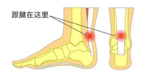 跟腱断裂示意图（图片来自于网络）