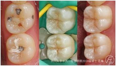 “织刻雕绣”全拿下！川大口腔医学生“巧手养成记”