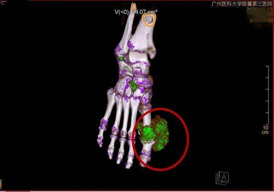  CT检查下可见李先生足部鹅蛋大的痛风石