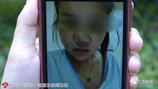 整形后鼻子歪了医院一句话惊呆女子：我们多存了你的肋骨，可修复