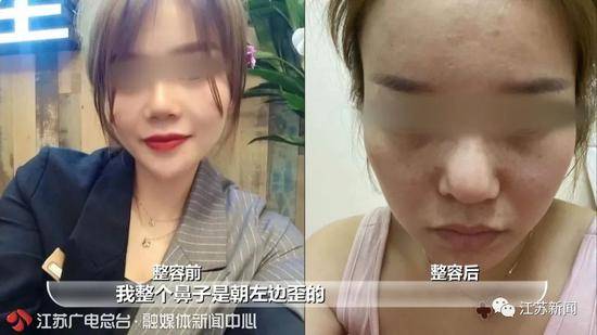 整形后鼻子歪了医院一句话惊呆女子：我们多存了你的肋骨，可修复