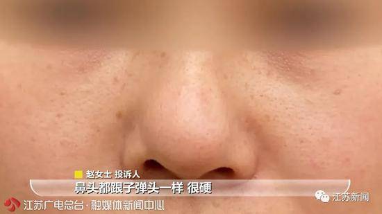 整形后鼻子歪了医院一句话惊呆女子：我们多存了你的肋骨，可修复