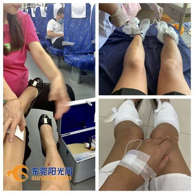 △王女士搭乘莞惠城际出行时腿部受伤的照片