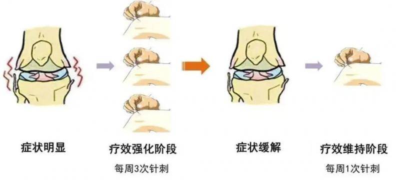 国际顶刊发表北中医学者针刺治疗膝骨关节炎系列研究