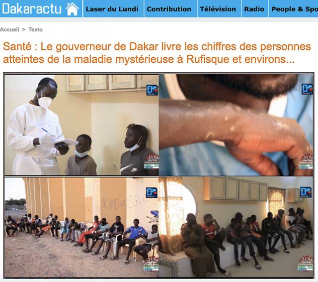 塞内加尔100多人感染不明疾病 渔民集体出现结痂性皮疹