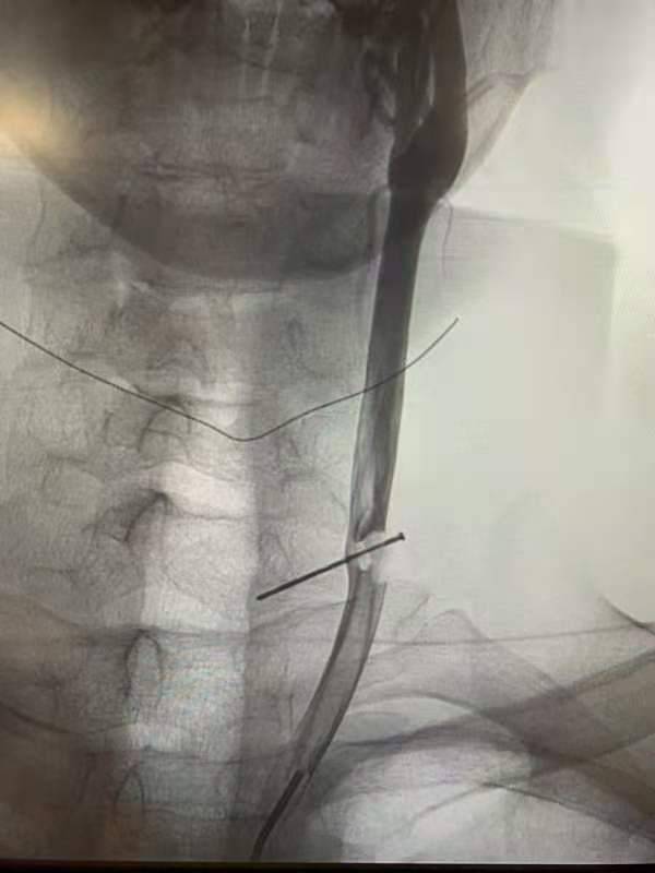 影像学检查显示：横在颈动脉的钉子本文图片均为台州医院提供