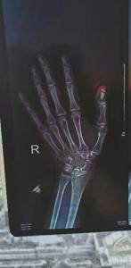 CT显示李女士的拇指受伤。