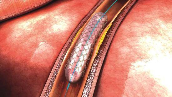 球囊导管将堵塞血管撑开后撤走，易出现动脉弹性回缩、血管内粥样硬化斑块破碎脱落，术后再狭窄、血栓等状况。为解决上述问题，心脏支架应运而生。图/IC