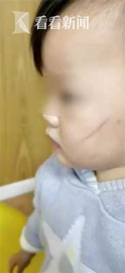 2岁女儿被老师指甲戳伤 家长：半年内第6次受伤