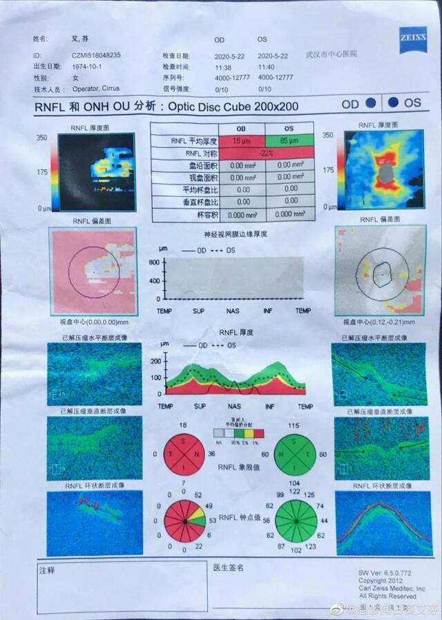 艾芬白内障手术前OCT检查报告。来源：艾芬提供