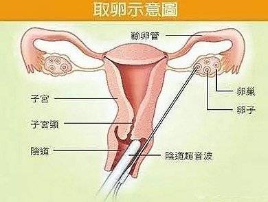 起底代孕背后黑产链：地下机构超400家暴利高达60%