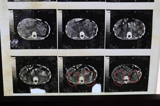 1997年1月29号手术前CT显示：双肾形态密度正常