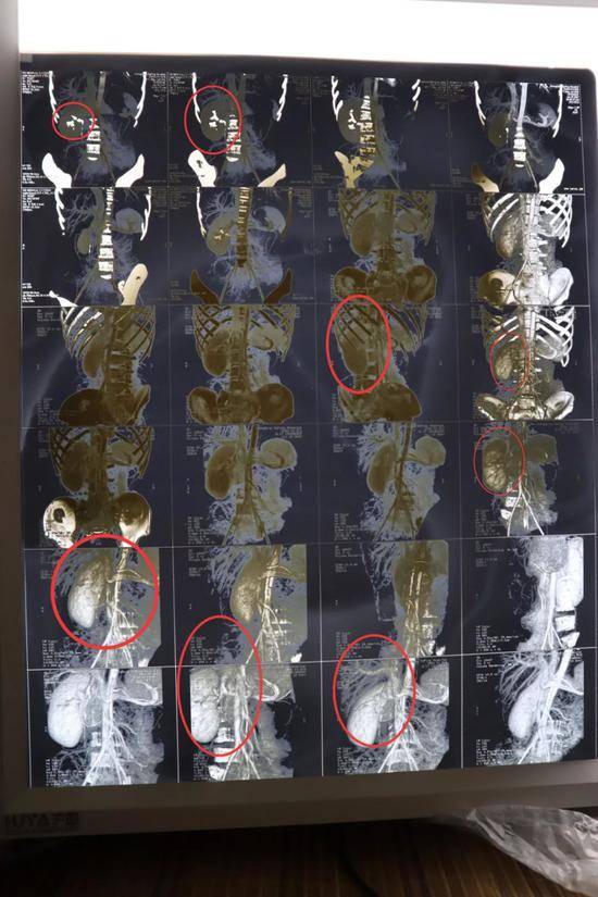 2007年6月15日重庆大坪医院CT显示：右肾正常，左肾缺如