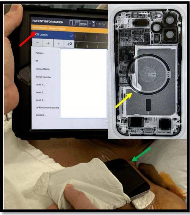 实锤！iPhone 12可逼停心脏除颤器 磁场超安全阈值30倍