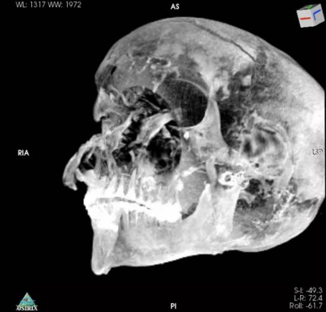 距今约3600年的古埃及第十七王朝法老塞格嫩拉是在与希克索斯人的战斗中被杀害