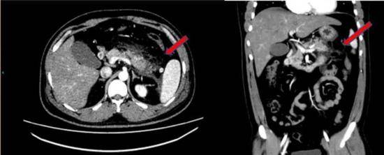 腹部增强CT提示胰腺尾部肿胀，胰腺周围脂肪间隙模糊，多发斑片状、条索影。红色箭头示胰腺脂肪间隙。