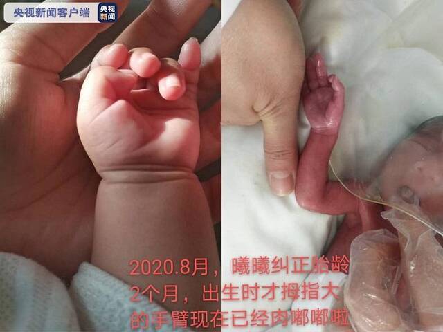 出生只有900克 早产“拇指姑娘”在呵护中健康成长