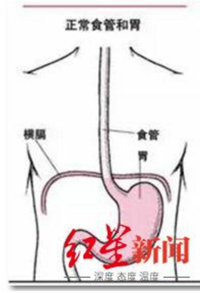 ↑正常食管和胃的位置关系。