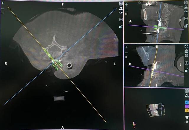 颈6椎体前路右侧椎弓根螺钉规划示意图
