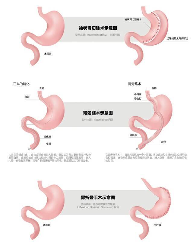 一年10000例！“切胃减肥”被滥用还是切得不够？