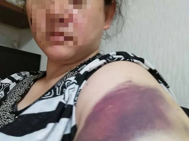 2018年，因为阻止小辉玩游戏，江欣左臂被小辉打伤，深紫色淤青明显。受访者供图