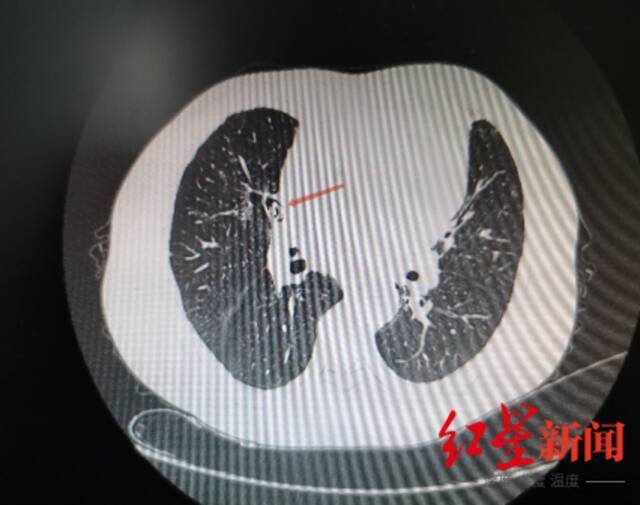↑CT影像资料下看到的肺部异物