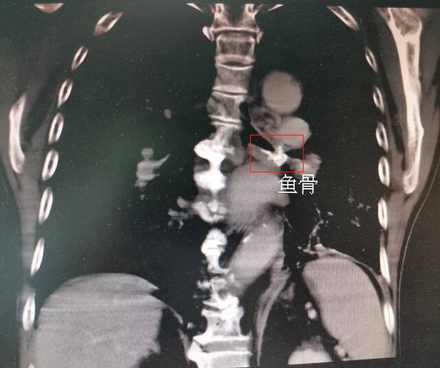 广东一老伯鱼骨卡气管近60年没取，医生：实属罕见