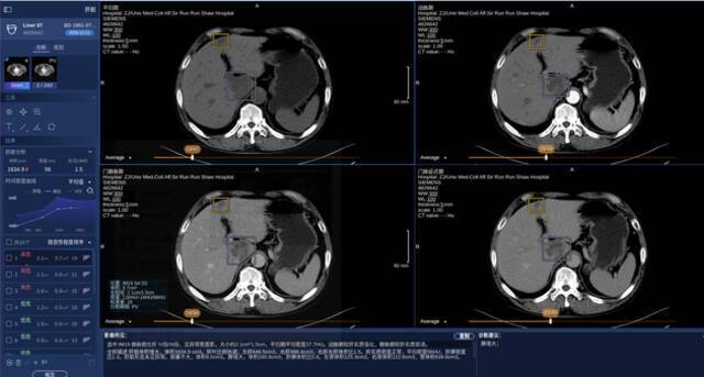 商汤科技SenseCare®️肝脏CT智能临床解决方案产品界面