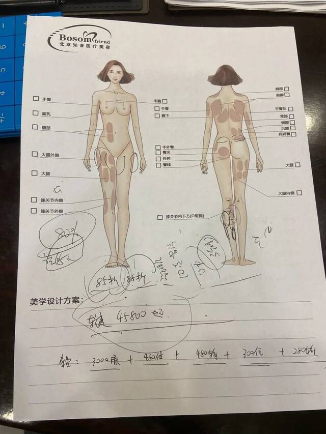 北京知音医疗美容门诊部向新京报记者出示的小腿肌肉阻断术示意图与价格。新京报记者李雨凝摄