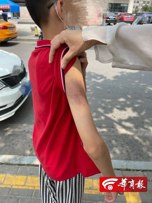 西安11岁男孩遭辅导班老师殴打全身多处淤青 警方介入调查