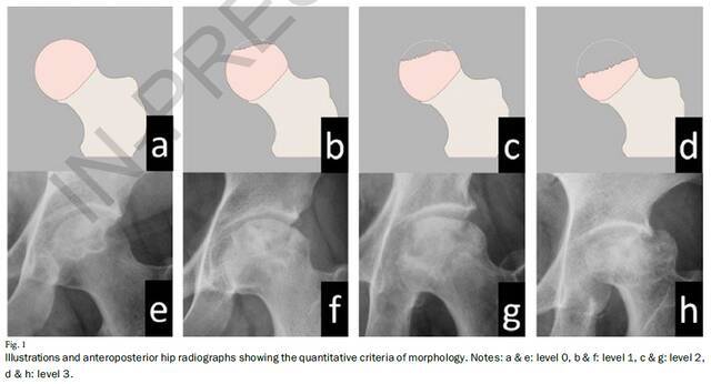 首次以“北京中医药大学”命名的股骨头坏死X线疗效评价方法在骨科国际顶刊JBJS上发表