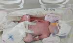 全国首例新冠肺炎确诊三胞胎孕妇在瑞丽顺利生产