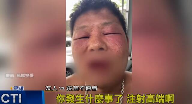 台湾一民众接种高端疫苗后脸部肿成“猪头” 岛内网友也看呆了